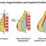 breast augmentation position of implants