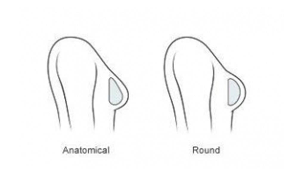 Fake vs natural breast implants