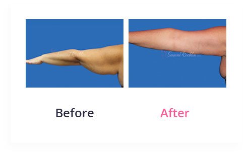 BeforeAfter arm lift2