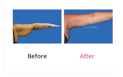 BeforeAfter Arm lift3
