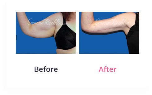 BeforeAfter Arm Lift5