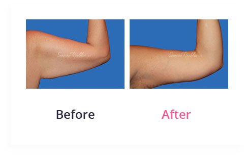 BeforeAfter Arm Lift6