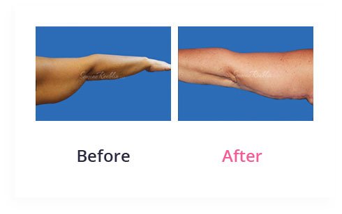 BeforeAfter Arm Lift8