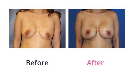 Breast-Augmentation-img-1