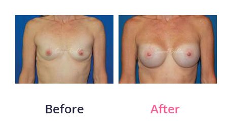 Breast-Augmentation-img-13