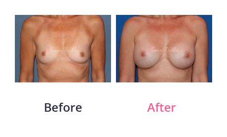 Breast-Augmentation-img-20