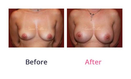 Breast-Augmentation-img-21