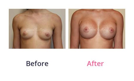 Breast-Augmentation-img-24