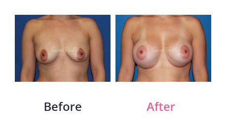 Breast-Augmentation-img-26