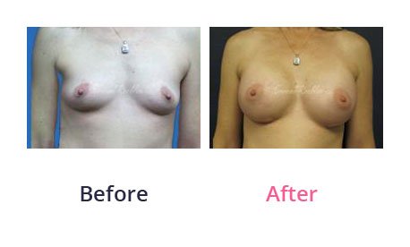 Breast-Augmentation-img-27