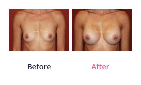 Breast-Augmentation-img-5
