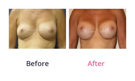 Breast-Augmentation-img-6
