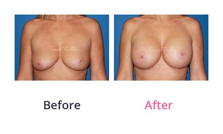 Breast-Augmentation-img-8