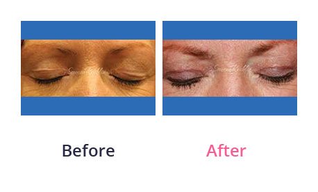 Eyelid-Surgery-img-39