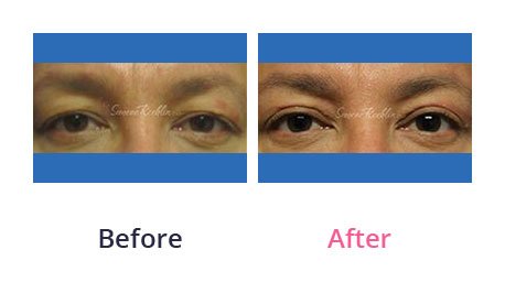 Eyelid-Surgery-img-46