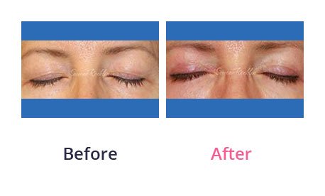 Eyelid-Surgery-img-7