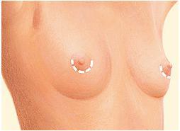 all nipple incision