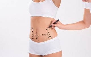 abdominoplasty