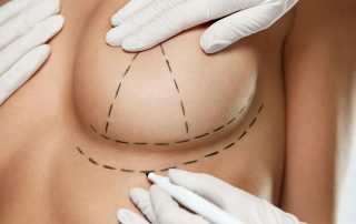 capsuloraphies