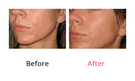 Chemical peel - before and after 01