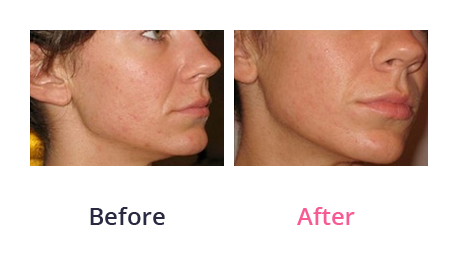 Chemical peel - before and after 02