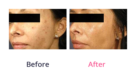 Chemical peel - before and after 03