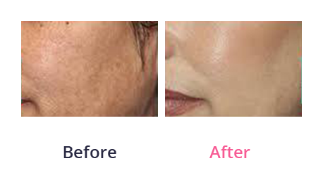 Chemical peel - before and after 04