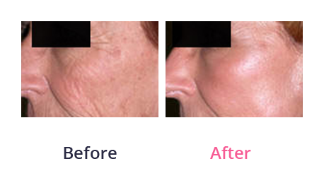 Chemical peel - before and after 05
