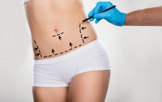 Surgeon Drawing Correction Lines On Woman's Stomach