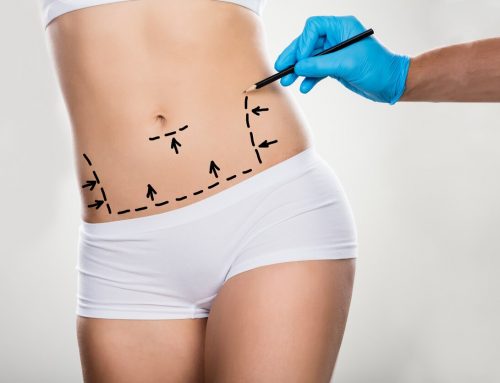 How to Prepare for Your Tummy Tuck Surgery?
