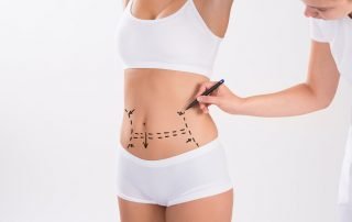 Surgeon Preparing Woman For Liposuction Surgery