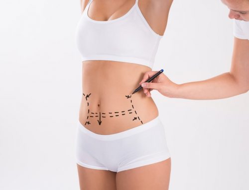 What Is the Difference Between Tummy Tuck and Liposuction?