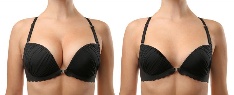 Different Types Of Breast Lifts Explained