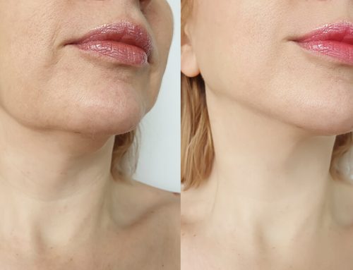Chin Liposuction Recovery Time
