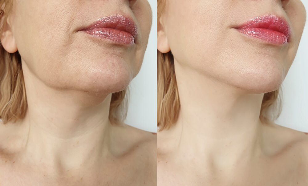 How Long Wear Compression After Chin Lipo? 