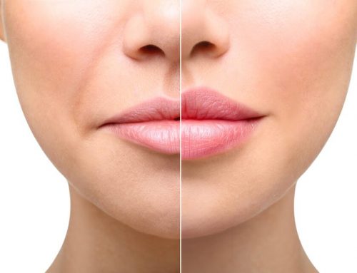 How to Reduce Swelling After Lip Injections and Fillers