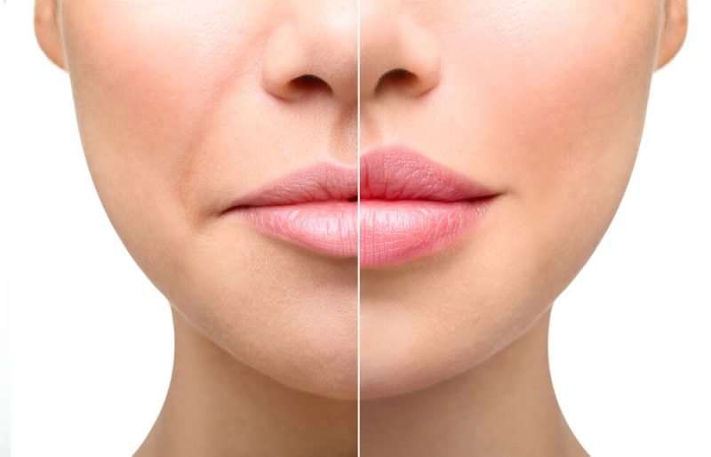 how-to-reduce-swelling-after-fillers-dr-semone-rochlin