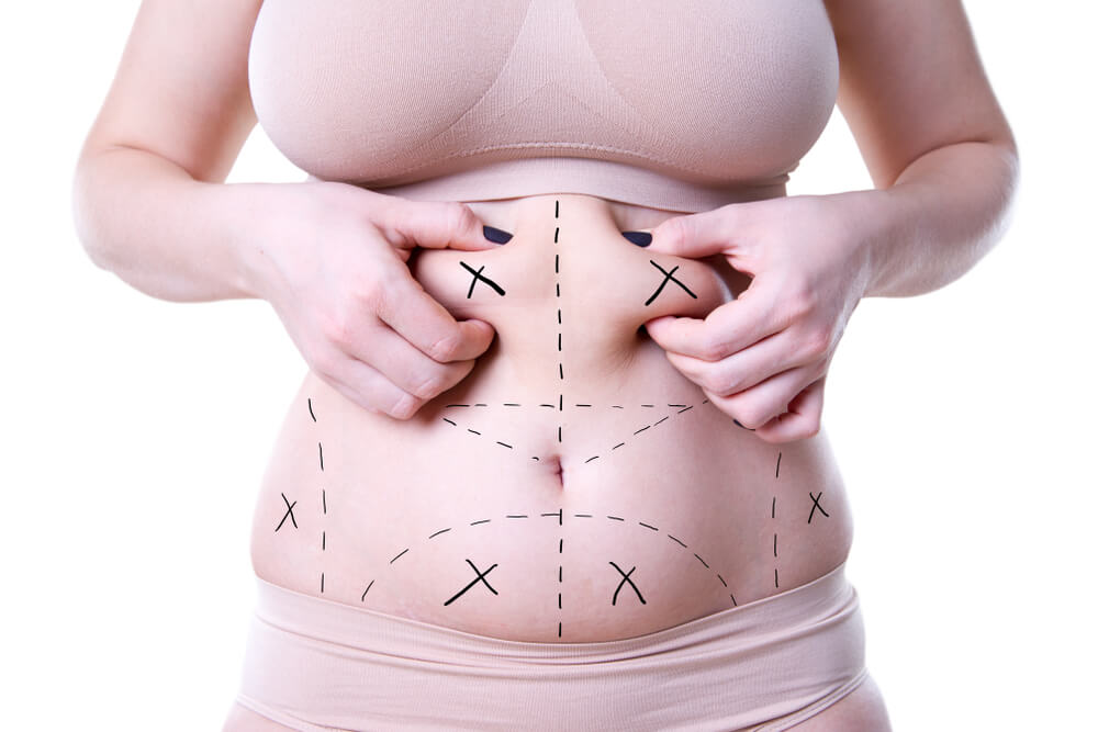 Woman Before Operation With Surgical Lines on Stomach