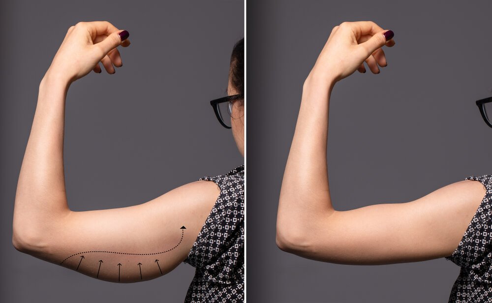 Woman's Arm Before & After the Operation