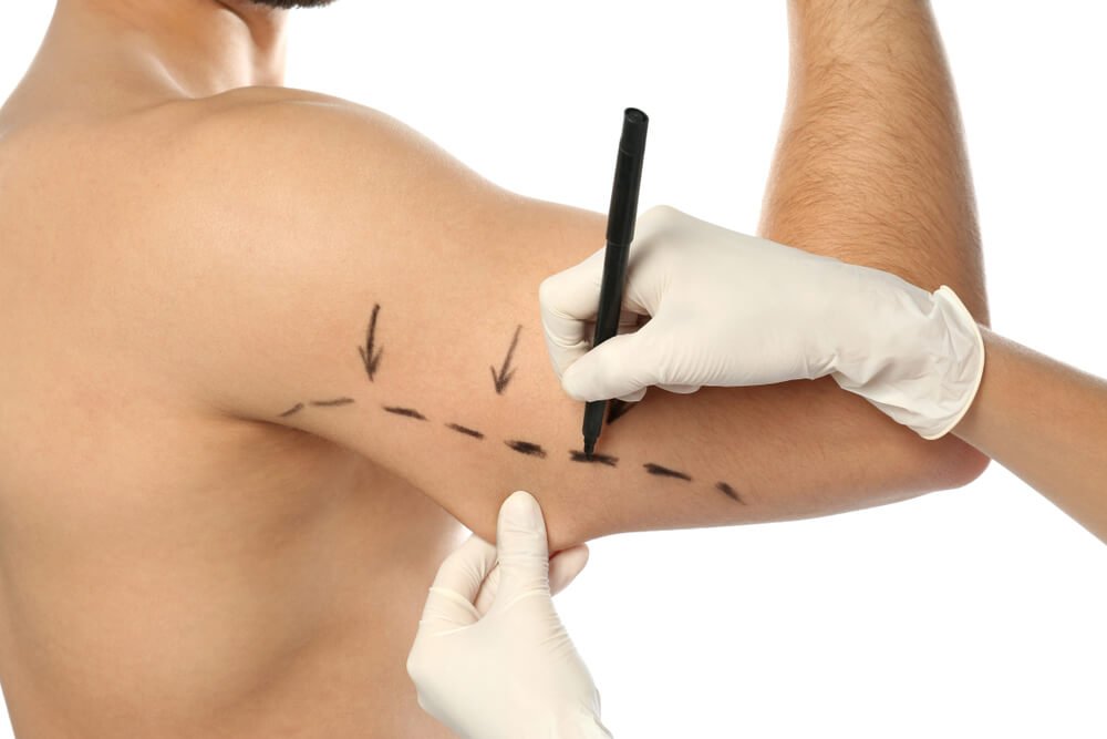 Doctor Drawing Marks on Man's Arm for Cosmetic Surgery Operation