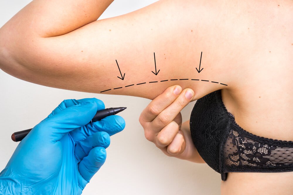 Plastic Surgery Doctor Draw Line on Patient Arm - Cosmetic Surgery Concept
