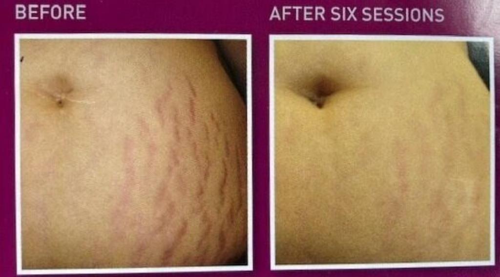 Before and after PRX treatment