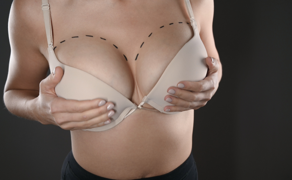 Breast Augmentation photo completed by Dr. Semone Rochlin