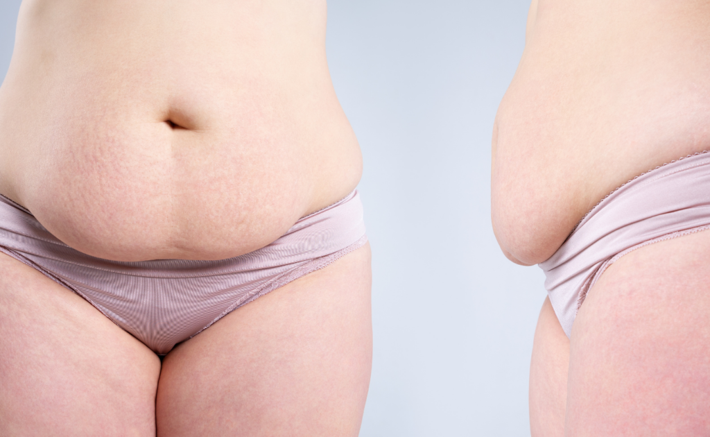 Get a Tummy Tuck with Dr. Rochlin in Scottsdale & Gilbert, AZ