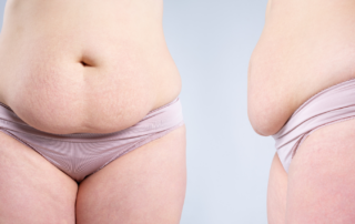 Get a Tummy Tuck with Dr. Rochlin in Scottsdale & Gilbert, AZ