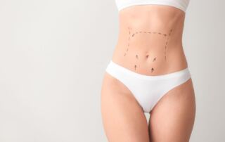A woman's abdomen with surgical markings for a cosmetic procedure.