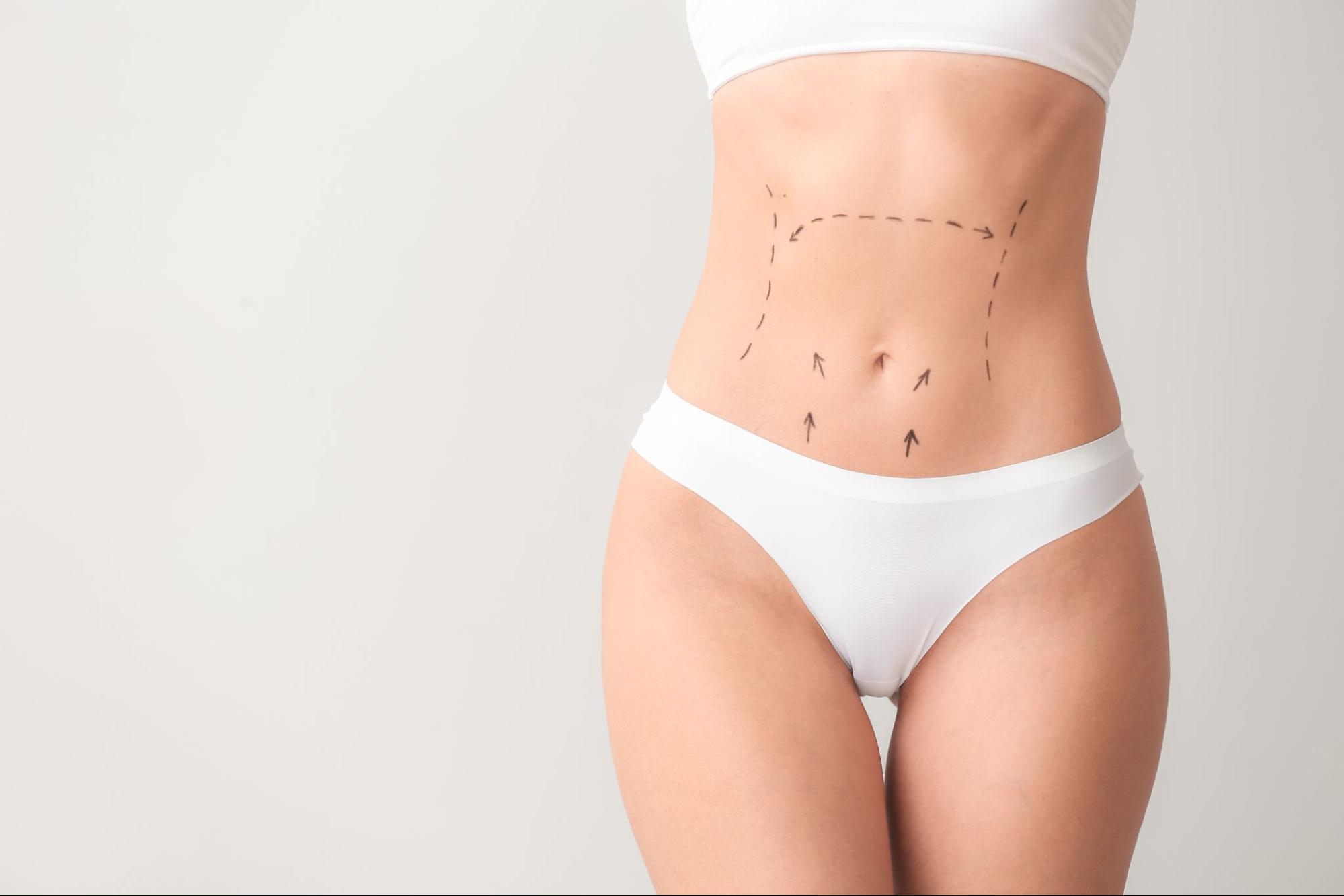 A woman's abdomen with surgical markings for a cosmetic procedure.