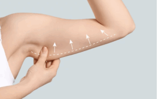 Person gently holding upper arm with arrows and dotted line indicating lifting and contouring areas for an arm lift (brachioplasty) procedure.