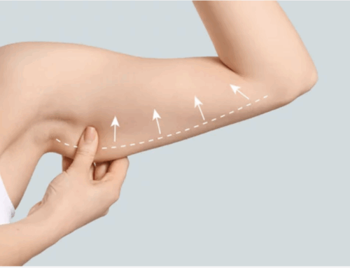 How Much Does Arm Lift Cost? All You Need to Know