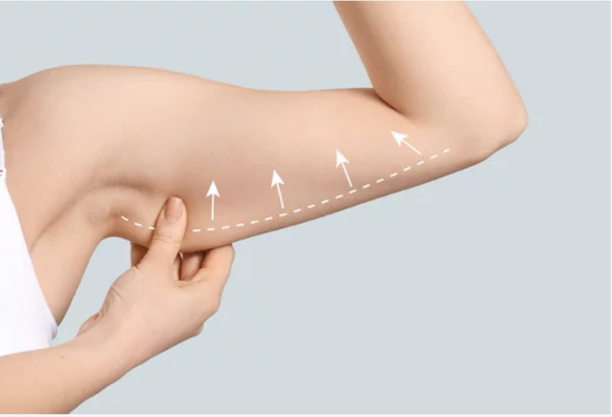 Person gently holding upper arm with arrows and dotted line indicating lifting and contouring areas for an arm lift (brachioplasty) procedure.
